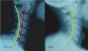 Before and after chiropractic care