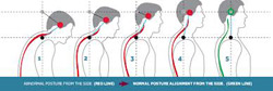 Abnormal to Normal Posture Alignment