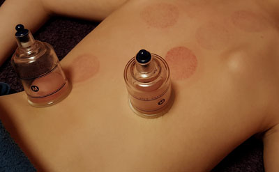 Cupping Therapy Waterloo ON | Price Chiropractic