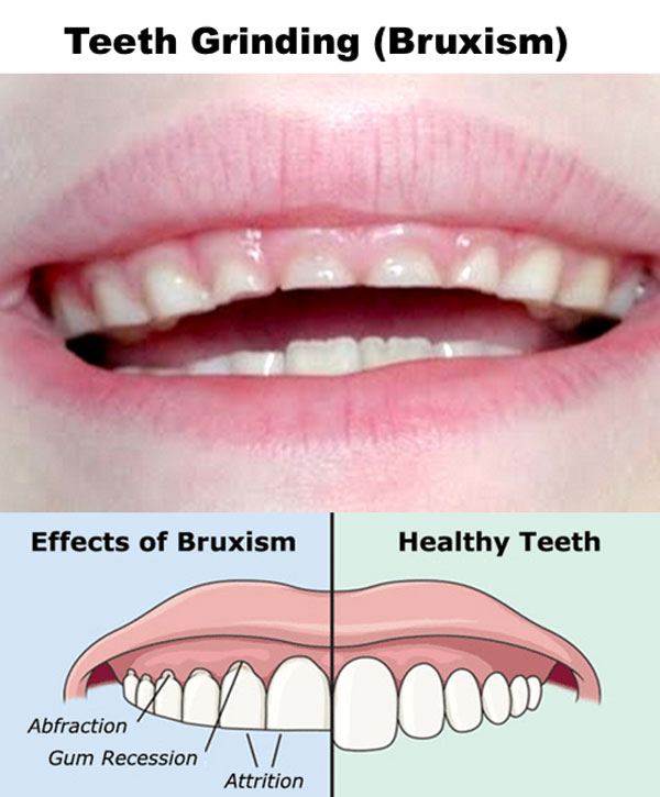 The Grinding Of Teeth