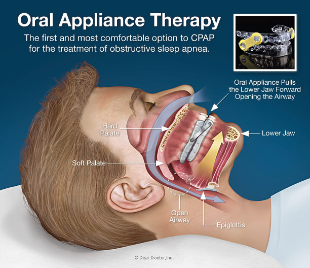 oral-appliance-therapy.jpg