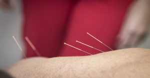needling-Therapy