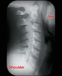 X-ray of normal side view of neck