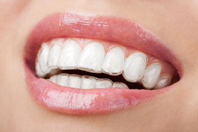 close up of aligners on teeth