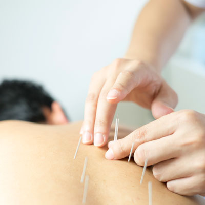 Applying acupuncture needle