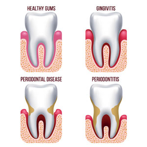 Gum & Periodontal Health at Shine Dentists