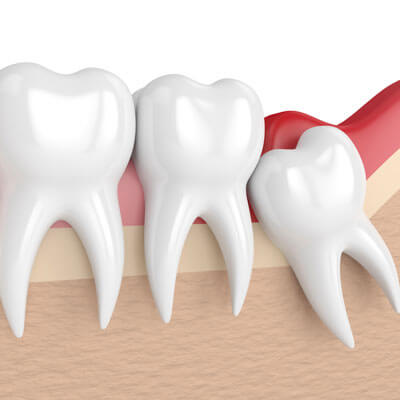 Wisdom tooth illustration