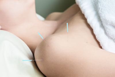 Woman with acupuncture needles in shoulder