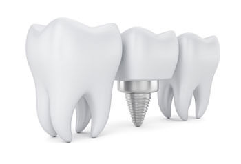 Dental Implants {PJ}