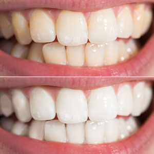 teeth comparison before and after teeth whitening