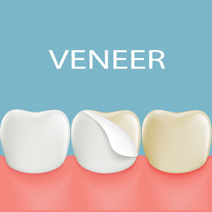 Veneers at Shine Dentists